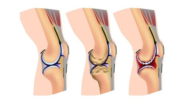 stadia artrózy kolenního kloubu