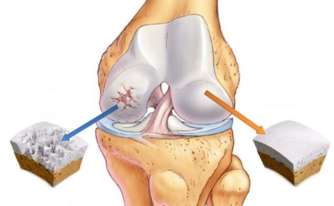 zdravá chrupavka a artróza kolena