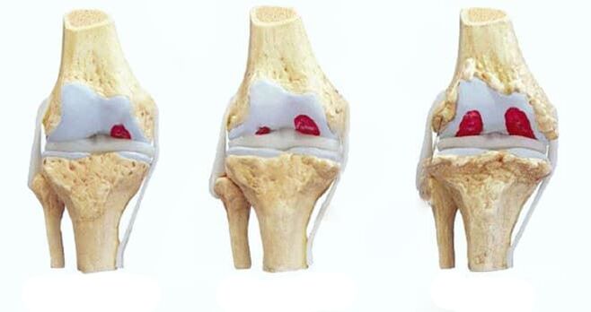 stádia osteoartrózy kolena
