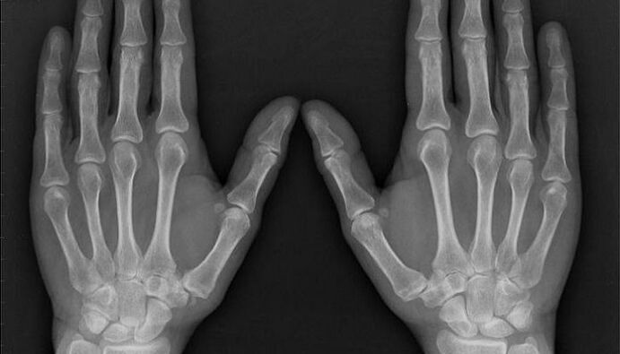 rentgen pro diagnostiku artritidy a artrózy