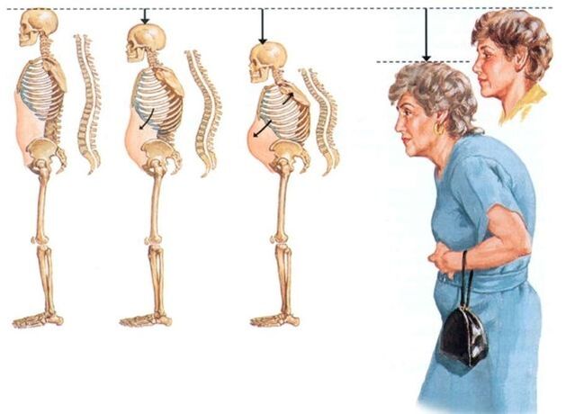 stadia cervikální osteochondrózy