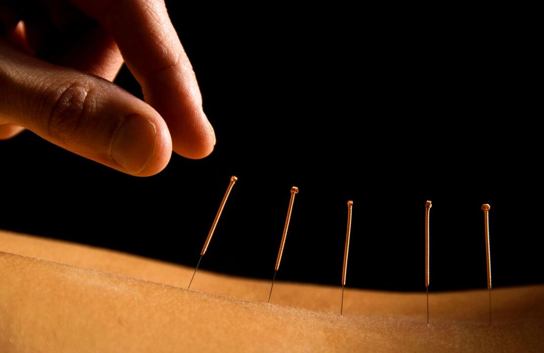 akupunktura při bolestech zad