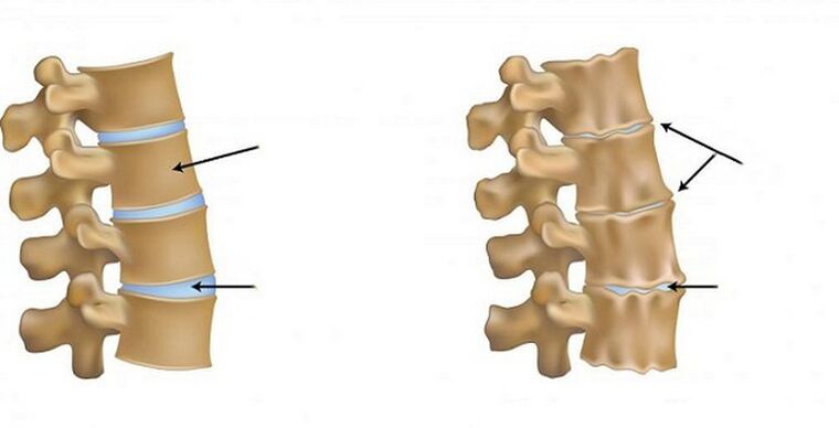 Ischemický syndrom pro osteochondrosu