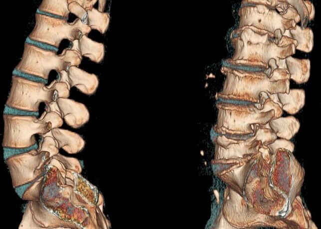 Osteochondrosis bederní oblasti