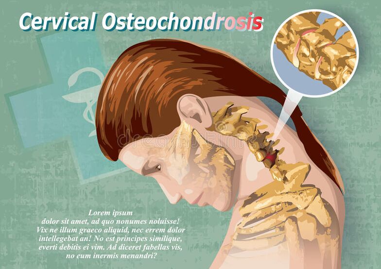Cervikální osteochondrosis je onemocnění chrupavkové tkáně
